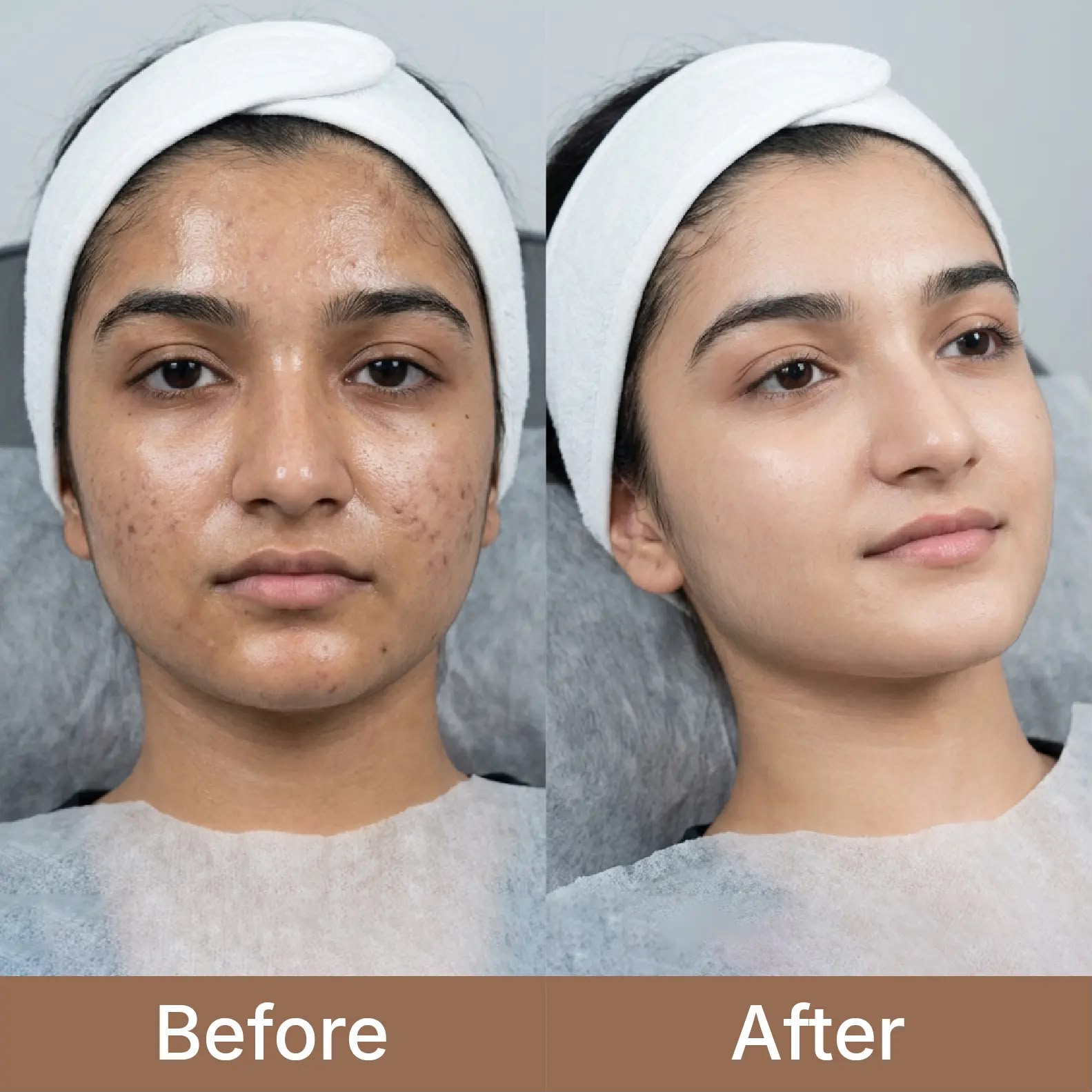 Carbon Laser Peel Vadodara